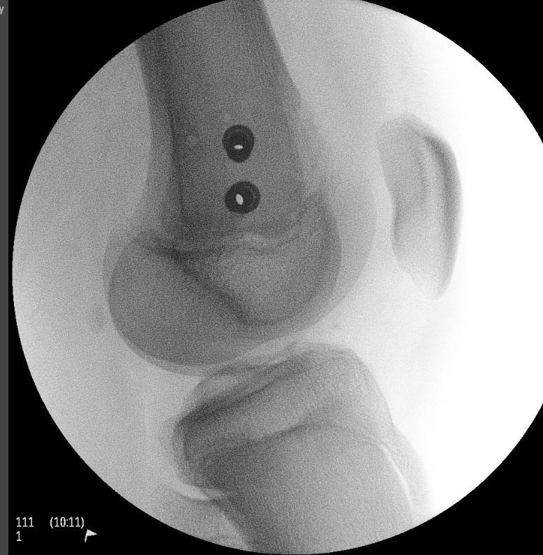 Distal Femur SH2 Lateral